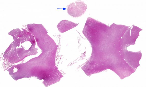 1H2 MS, Secondary Progressive, fulminant (Case 1) Optic N H&E WM