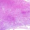 1H3 MS, Secondary Progressive, fulminant (Case 1) Optic n-Chiasm H&E 1