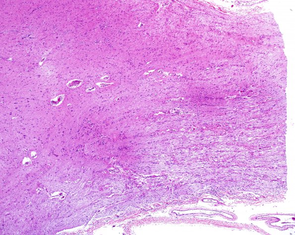 1H3 MS, Secondary Progressive, fulminant (Case 1) Optic n-Chiasm H&E 1