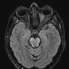 1I1 MS, Secondary Progressive, fulminant (Case 1) 7-2015 TIRM 2 - Copy