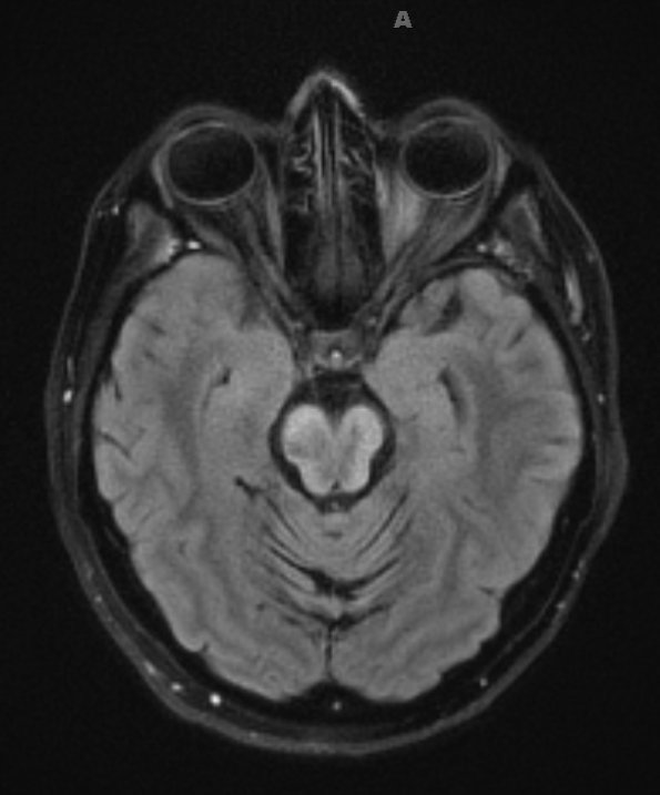 1I1 MS, Secondary Progressive, fulminant (Case 1) 7-2015 TIRM 2 - Copy