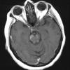 1I3 MS, Secondary Progressive, fulminant (Case 1) 7-2015 T1 with contrast 2 - Copy