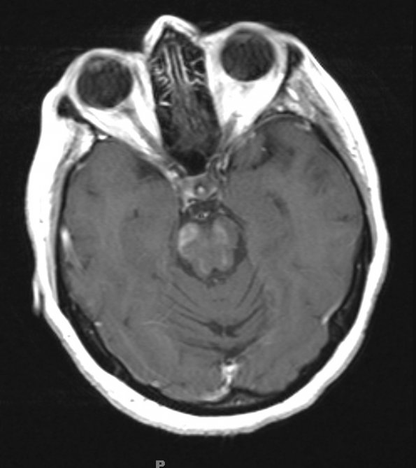 1I3 MS, Secondary Progressive, fulminant (Case 1) 7-2015 T1 with contrast 2 - Copy