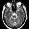 1I4 MS, Secondary Progressive, fulminant (Case 1) 7-2015 T2 2 copy - Copy