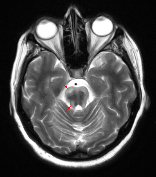 1I4 MS, Secondary Progressive, fulminant (Case 1) 7-2015 T2 2 copy - Copy