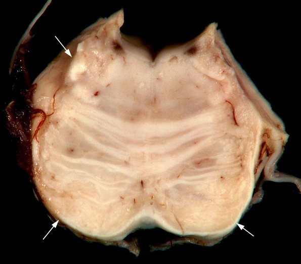 1K1 MS, Secondary Progressive, fulminant (Case 1) 8 copy