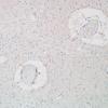 1K11 MS, Secondary Progressive, fulminant (Case 1) N7 CD20