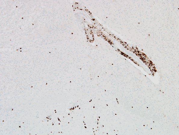 1K9 MS, Secondary Progressive, fulminant (Case 1) N7 CD8 2