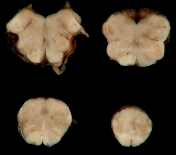 1L1 MS, Secondary Progressive, fulminant (Case 1) 10