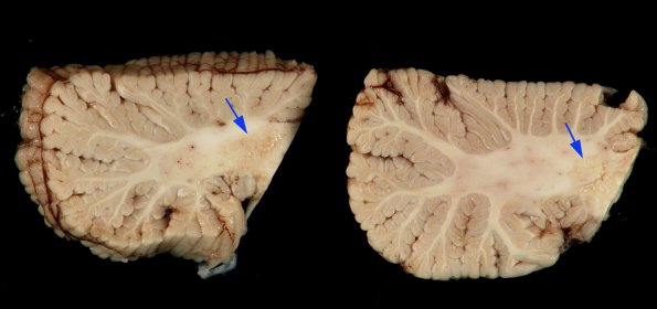 1M1 MS, Secondary Progressive, fulminant (Case 1) 2 copy