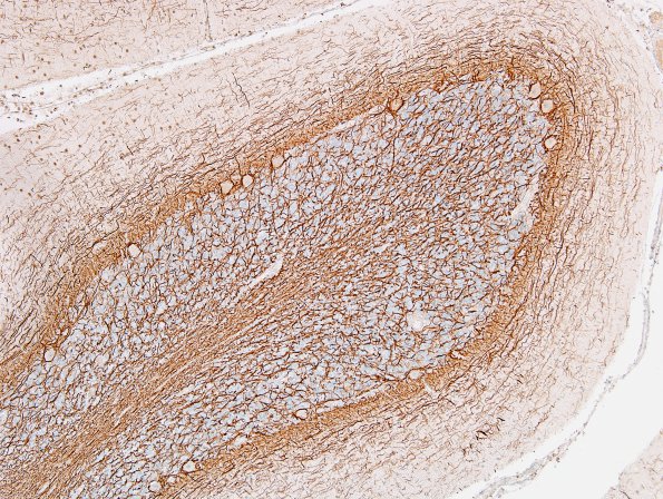 1N2 MS, Secondary Progressive, fulminant (Case 1) nl area NF 2