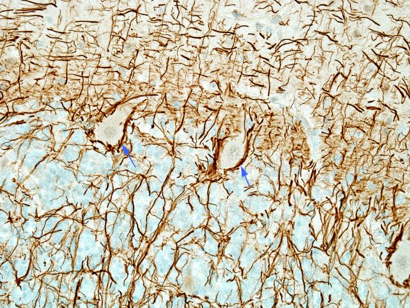 1N3 MS, Secondary Progressive, fulminant (Case 1) nl area NF 5 copy