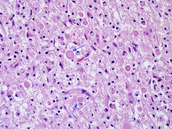 1P2 MS, Secondary Progressive, fulminant (Case 1) peri-dentate WM H&E 1 copy