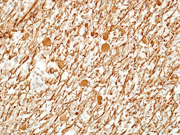 1P3 MS, Secondary Progressive, fulminant (Case 1) peri-dentate WM NF 3