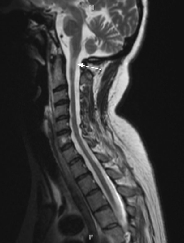 1Q2 MS, Secondary Progressive, fulminant (Case 1) 7-2015 T2 no contrast copy - Copy