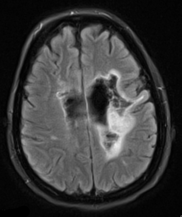 1A1 NMO (Case 1) MRI 5 TIRM BLADE 1 - Copy