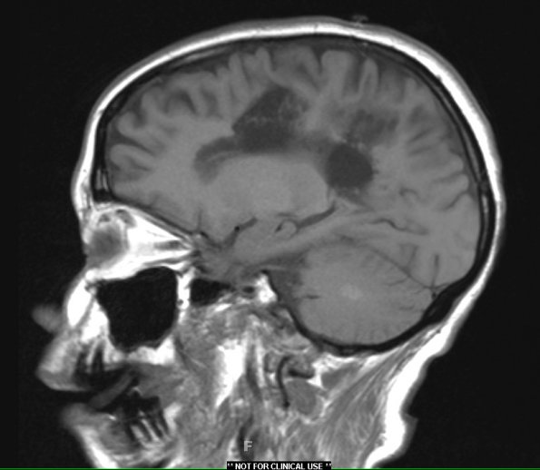 1A3 NMO (Case 1) T1 no contrast - Copy