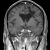 1A4 NMO (Case 1) MRI 2 T1 W 3 - Copy