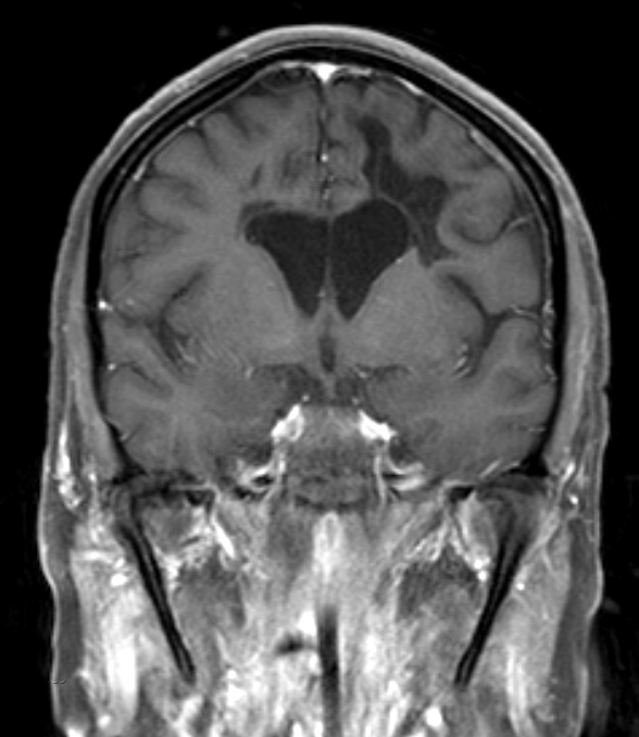 1A4 NMO (Case 1) MRI 2 T1 W 3 - Copy