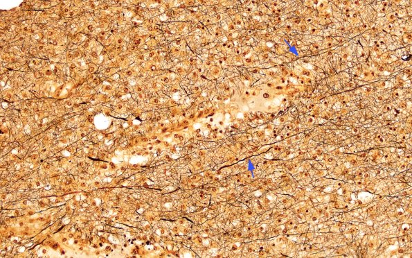 1C14 NMO (Case 1) Biels 20X jct of dystrophic Biels 1 copy