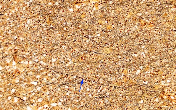 1C15 NMO (Case 1) Biels 20X jct of dystrophic 2 copy