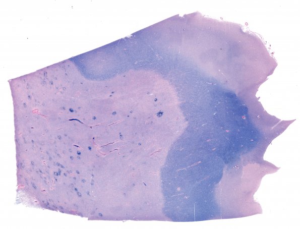 1C6 NMO (Case 1) N16 Solachrome cyaniin WM 1A