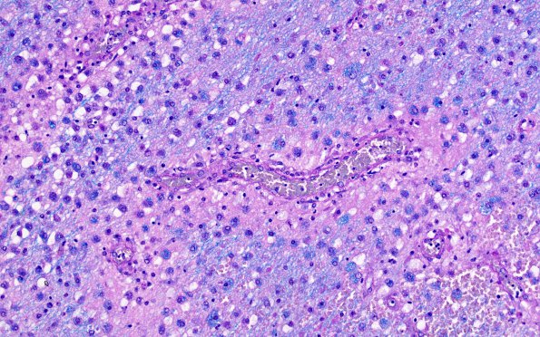 1C8 NMO (Case 1) LFB-PAS 40X no GFAP area 2