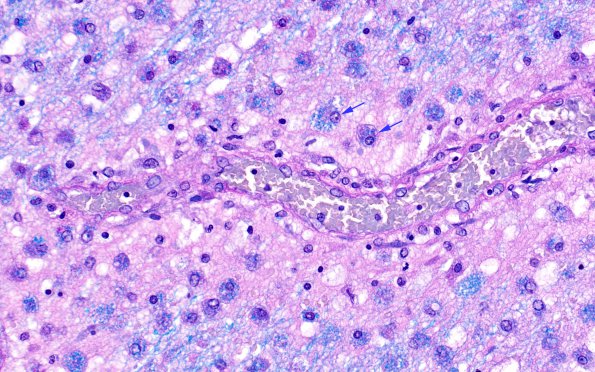 1C9 NMO (Case 1) LFB-PAS 40X no GFAP area copy