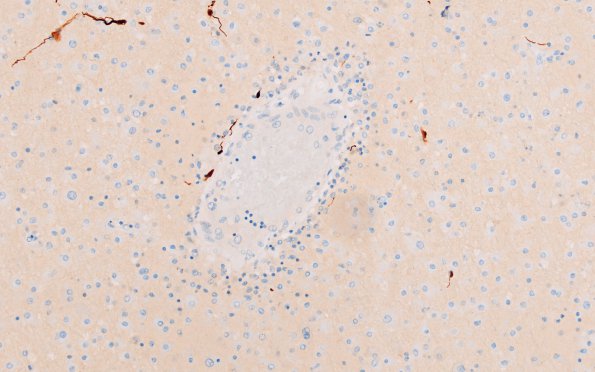 1D9 NMO (Case 1) N16 GFAP 20X 3