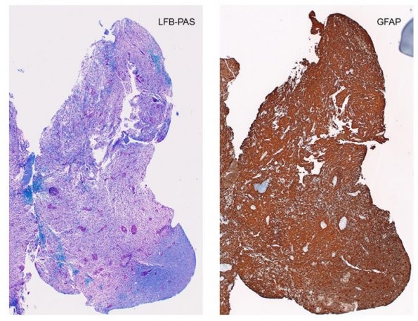 1E1 MS pattern use for comparison to NMO