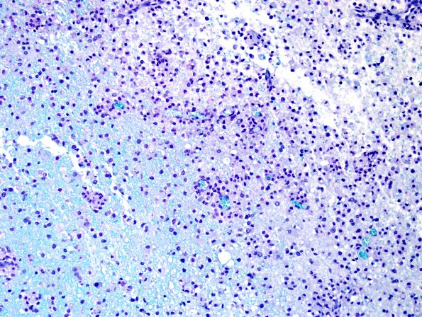 1E2 MS, active (Case 1b) compare with NMO LFB-PAS 20X