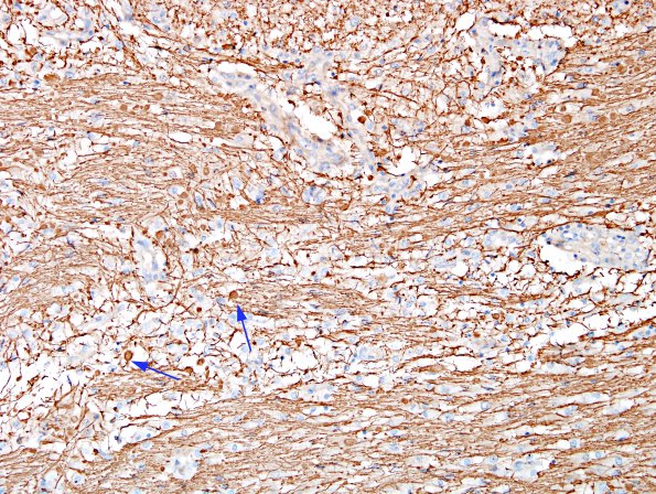 1L10 NMO (Case 1) N7 NF 2 copy