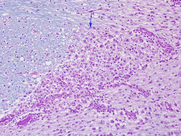 1L6 NMO (Case 1) N7 2 LFB-PAS 20x Compare with Biels B copy