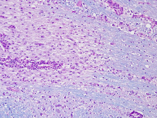 1L8 NMO (Case 1) N7 3 LFB-PAS 20x Compare with Biels C