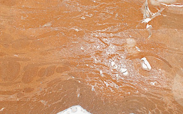 1M7 NMO (Case 1) N7 pons same focus 2X NF