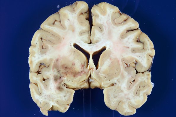 2B NMO Spectrum Disorder (Case 2) Gross