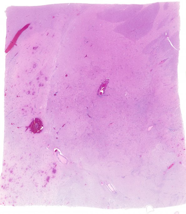 2C1 NMO (Case 2) Basal Ganglia A1 whole mount H&E