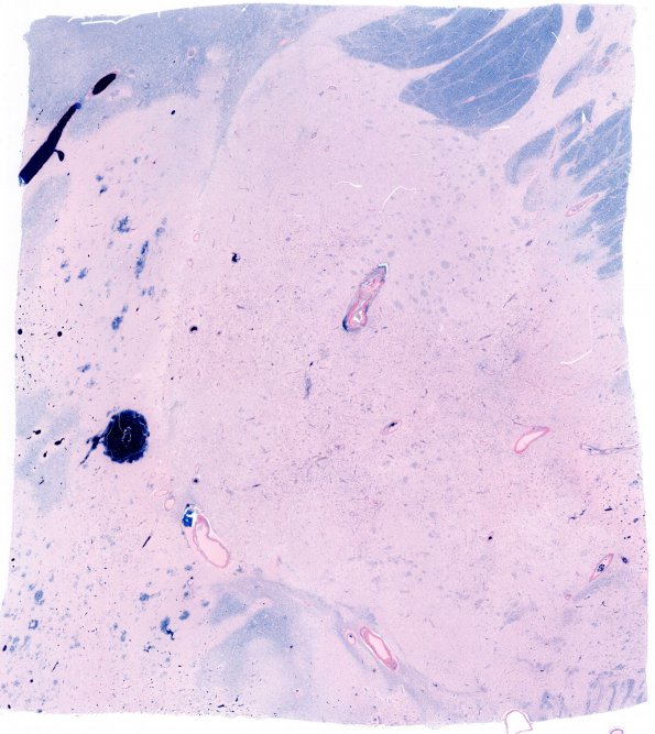 2C3 NMO (Case 2) Basal Ganglia A1 whole mount Solachrome cyanin