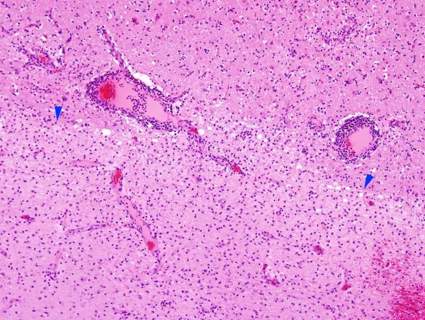 2D1 NMO (Case 2) H&E 10X edge copy