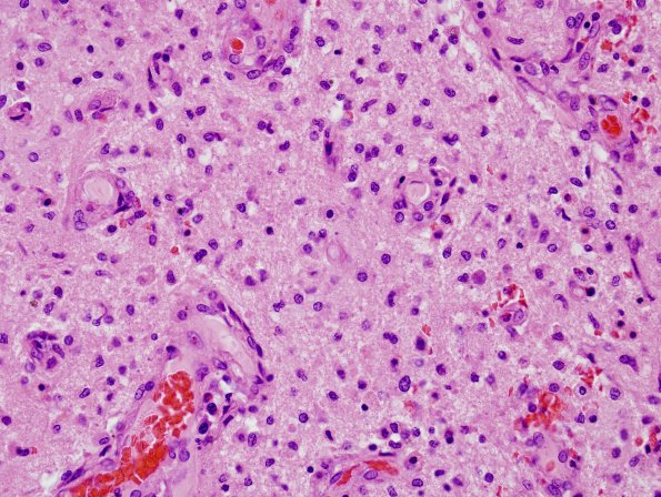 2D6 NMO Spectrum Disorder (Case 2) H&E 6