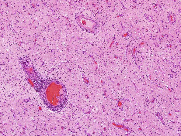 2D7 NMO Spectrum Disorder (Case 2) Basal Ganglia, H&E 15