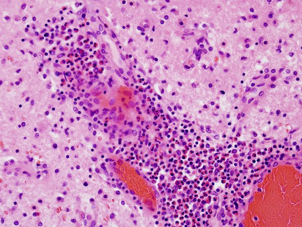 2D8 NMO Spectrum Disorder (Case 2) Basal Ganglia, H&E 17