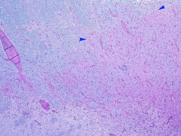 2E1 NMO Spectrum Disorder (Case 2) Demyelinative area LFB-PAS 4X copy