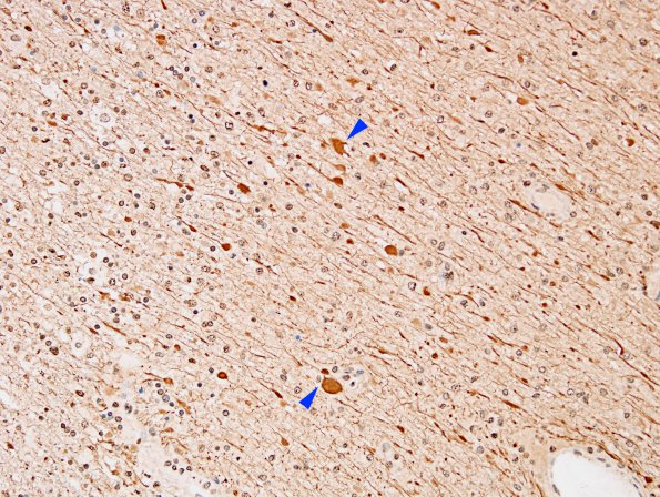 2E10 NMO Spectrum Disorder (Case 2) NF 3 copy