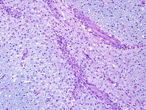 2E3 NMO Spectrum Disorder (Case 2) Demyelinative area LFB-PAS 20X