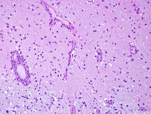 2E7 Neuromyelitis Optica Spectrum Disorder (Case 2) Area A LFB-PAS 20X