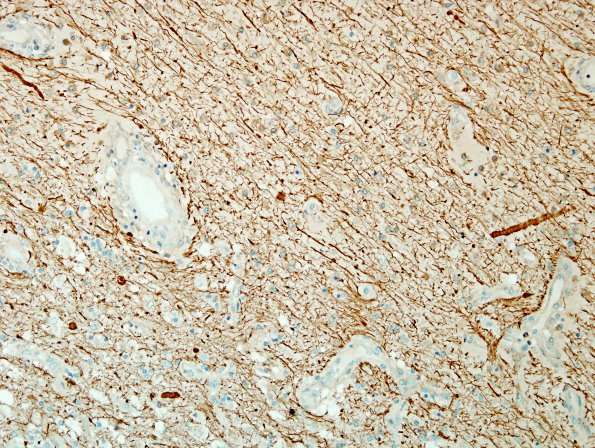 2E9 NMO Spectrum Disorder (Case 2) Area A Anti-NF 20X