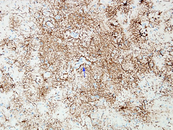 2F1 NMO Spectrum Disorder (Case 2) Anti-GFAP mild side 2 copy