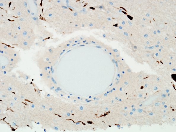 2F10 NMO Spectrum Disorder (Case 2) Anti-GFAP severe areas 9