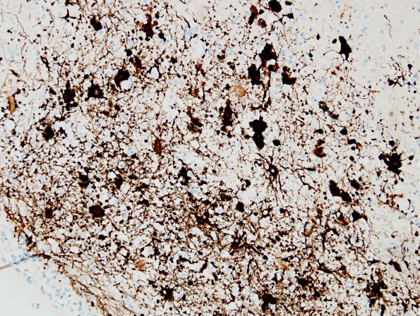 2F13 NMO Spectrum Disorder (Case 2) Anti-GFAP severe areas 4